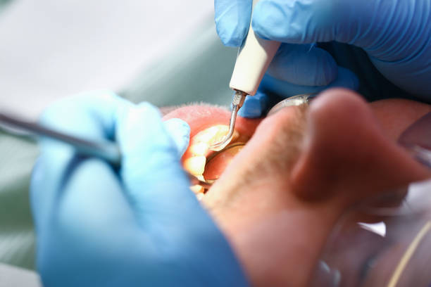 Best Emergency Root Canal Treatment in New Franklin, OH